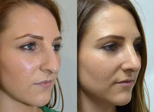 nose job results london male patient refined nasal bridge