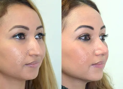 ethnic rhinoplasty london before after subtle refinement