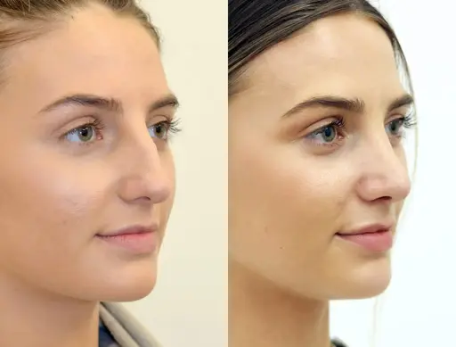 rhinoplasty london front view natural nose reshaping