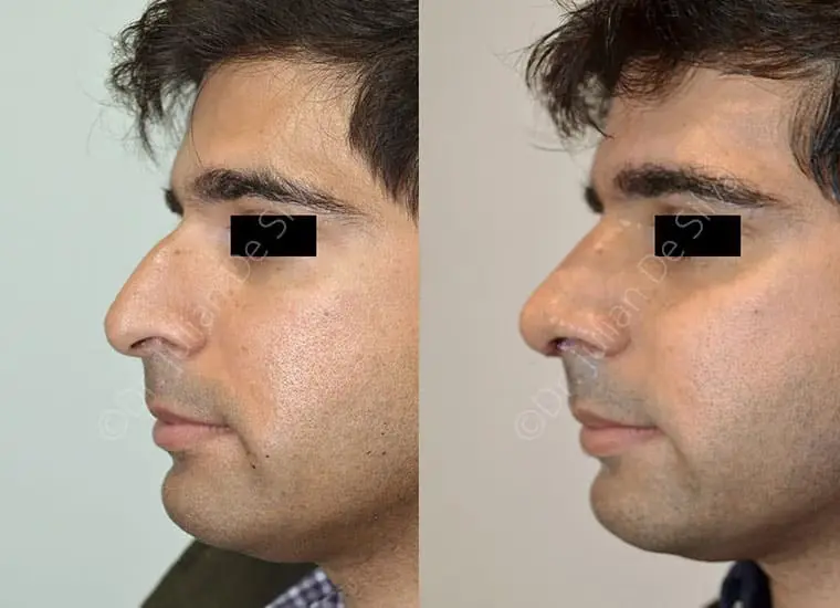 Male ethnic rhinoplasty before and after, man in his 30s