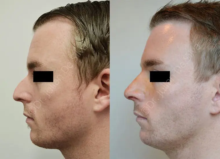 Male rhinoplasty before and after, 1 week after surgery