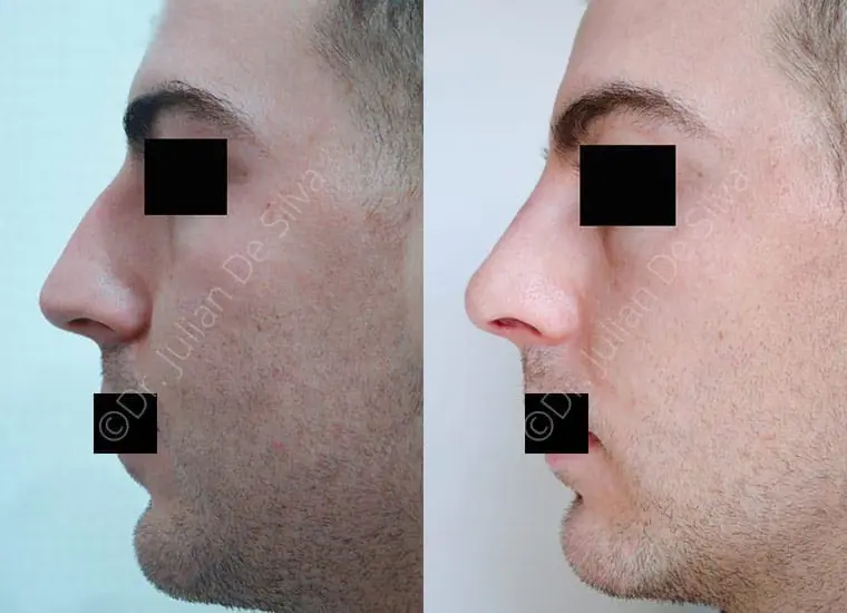 Male open rhinoplasty before and after, man in his 20s
