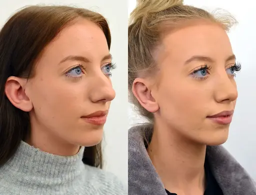 Rhinoplasty before and after, side profile, by Dr Julian De Silva